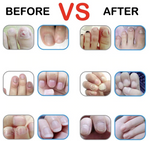 Advanced Fungal Nail Repair Pen